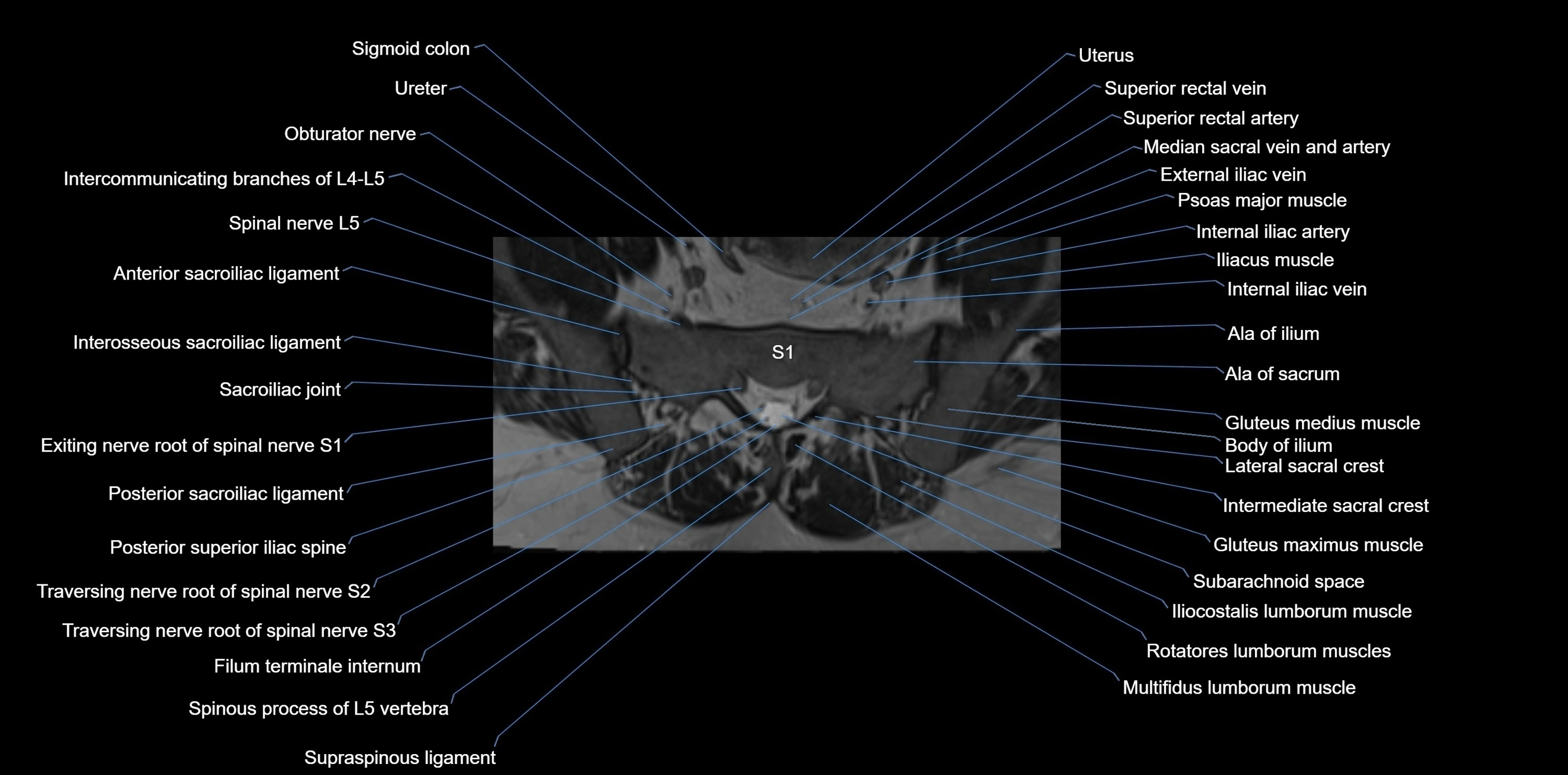 MRI sacrum, coccyx and sacroiliac joint axial cross sectional anatomy 3T  radiology  image-img-00001-00014.webp